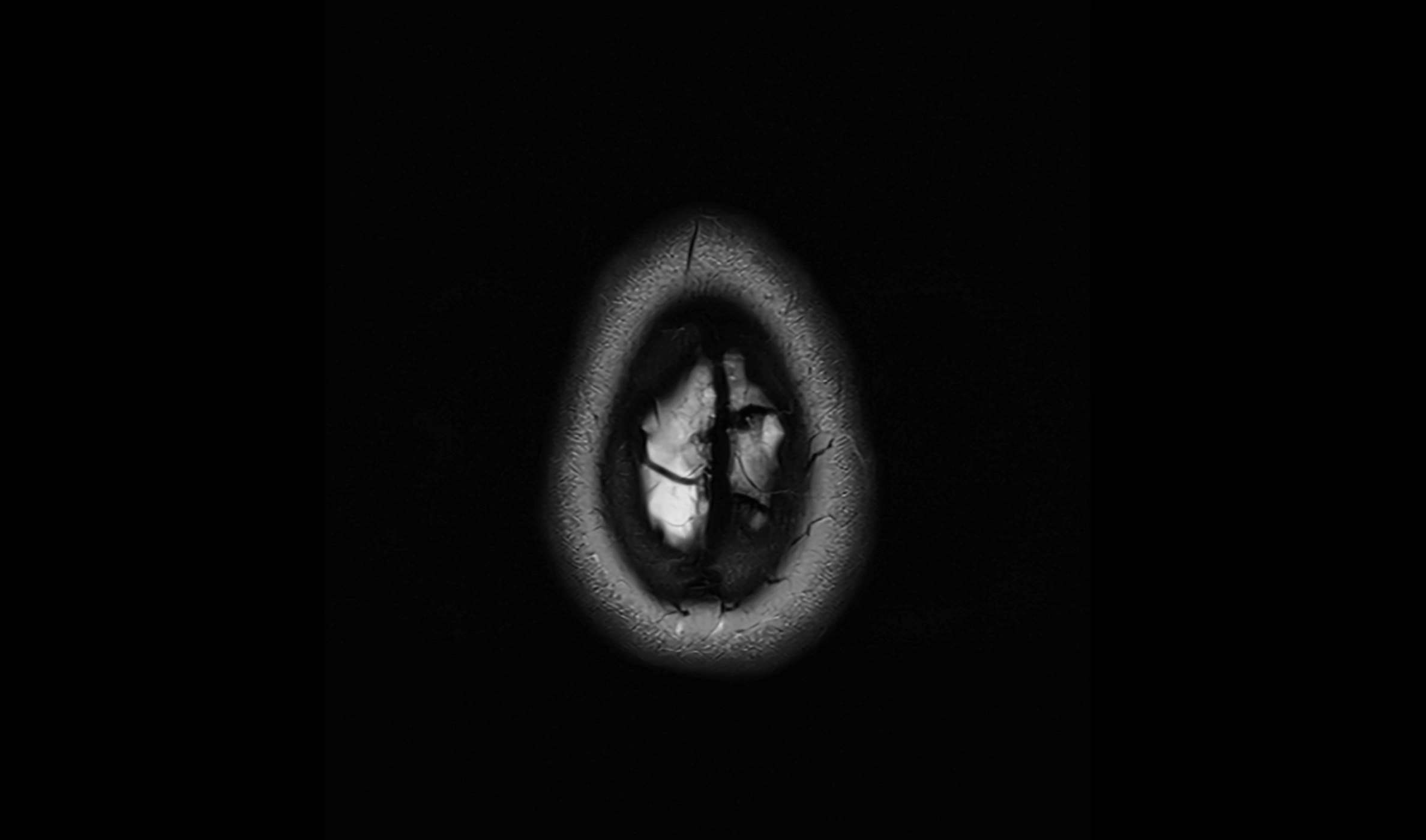 Brain cisterns  and ventricles  axial anatomy 3T MRI image-img-00001-00058.webp